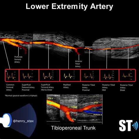 Arterial Sonography Of The Upper And Lower Extremities Sonographic Tendencies Vascular