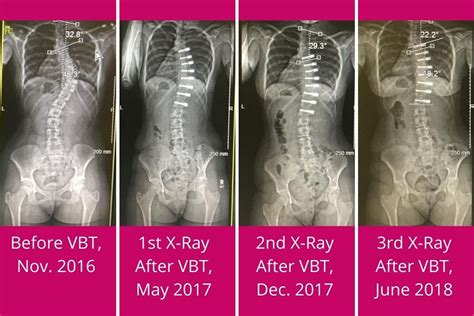 Vertebral Body Tethering A Sound Surgical Option To Treat Severe