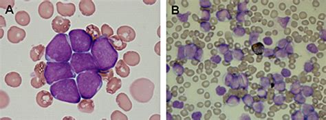 Lymphadenopathy And Hepatosplenomegaly In A Patient With Acute