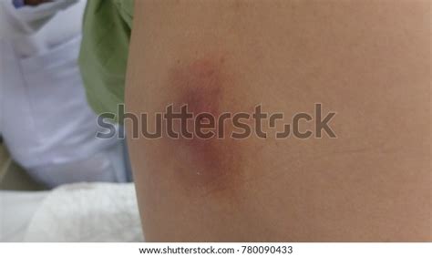 Infected Sebaceous Cyst Complicated Abscess Formation Stockfoto