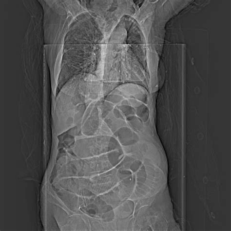 Incarcerated Obturator Hernia Presenting With Acute Abdomen