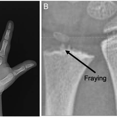 A Radiograph Of Left Hand At Initial Bone Age Bone Age Was 6 Years