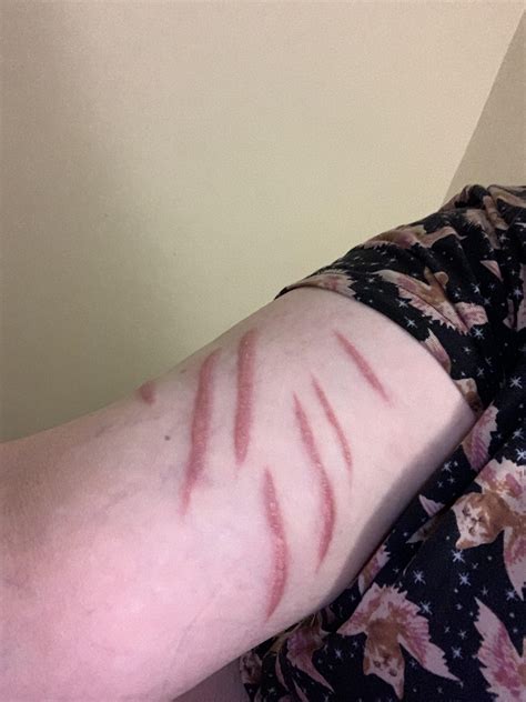 Advice I Am Really Self Conscious About My Upper Arms And I Have Scars