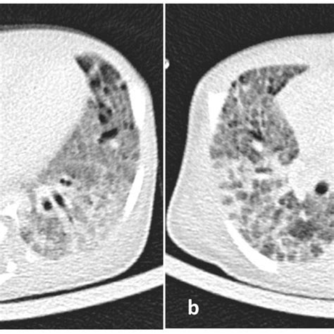 Ab A High Resolution Ct Hrct Of The Lungs Showing Patchy Areas Of