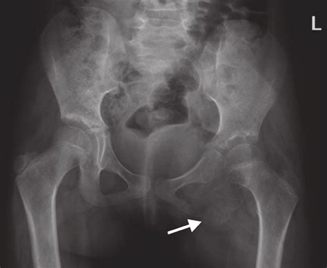 (1) the iliopectineal line (2) the ilioishchial line (3) the dome of the acetabulum (4) the tear drop (5) the (2)the ilioischial line is the radiographic landmark for the posterior column. -Pelvic x-ray with arrow pointing to an expansive lytic ...