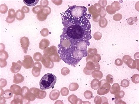 Cureus Report Of A Fatal Case Of Hemophagocytic Lymphohistiocytosis
