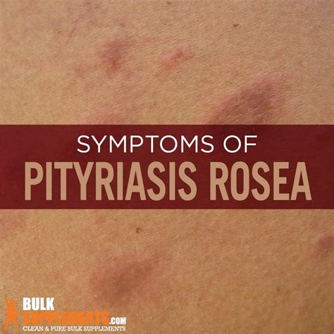 Pityriasis Rosea Symptoms Causes And Treatment