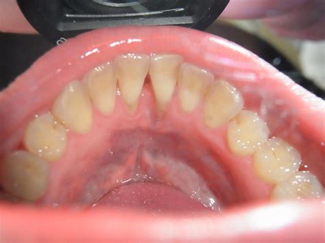 How A Tongue Piercing Can Cause Serious Damage To The Teeth And Gums
