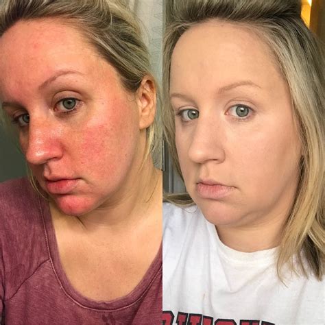 This Redditor Used It Cosmeticss Bye Bye Redness And The Before And