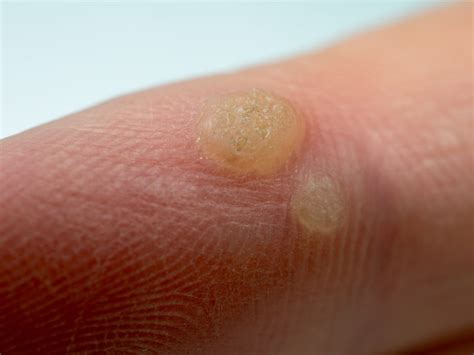 Images Of Ringworm On Hands 40 Vectors Stock Photos And Psd Files