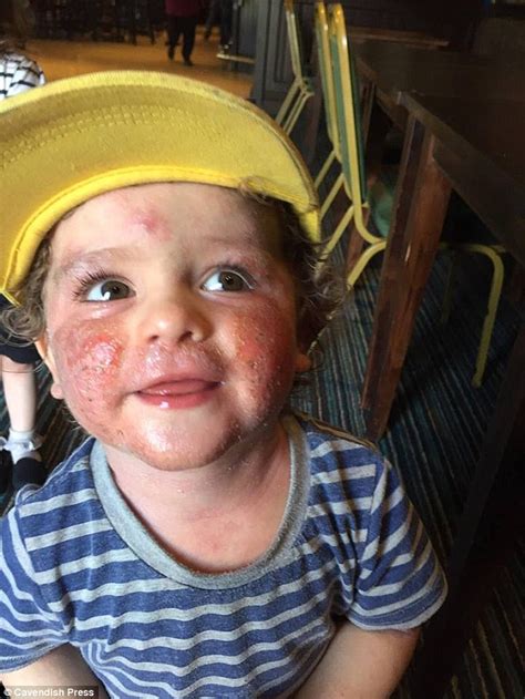 Toddler With Painful Eczema Is Shunned By Strangers Who Wrongly Think