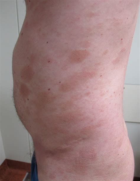 Acd A Z Of Skin Mycosis Fungoides