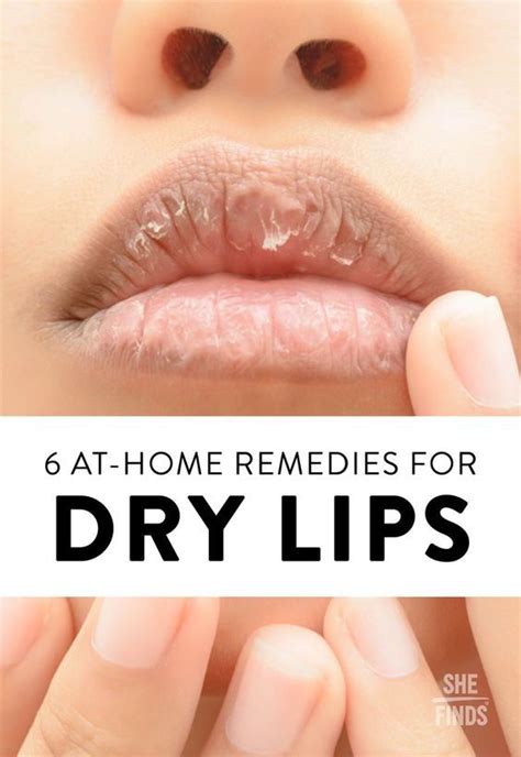6 At Home Remedies For Dry Lips Dry Lips Remedy Dry Lips Skin Remedies