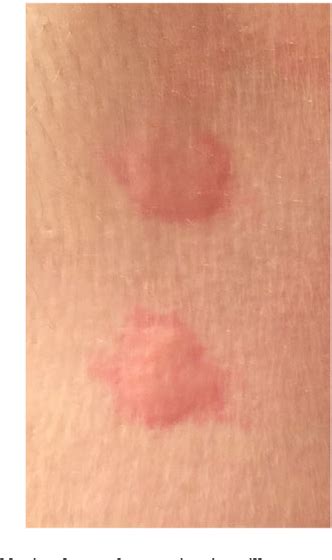 Allergic Reaction To Tick Bites