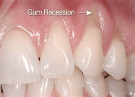 Gingival Recession Erica K Cummings Dds Magd D Abdsm General And