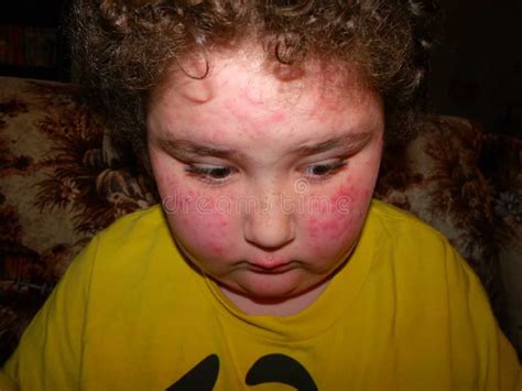 Réaction Allergique Image Stock Image Du Enfant Dégagement 31907247