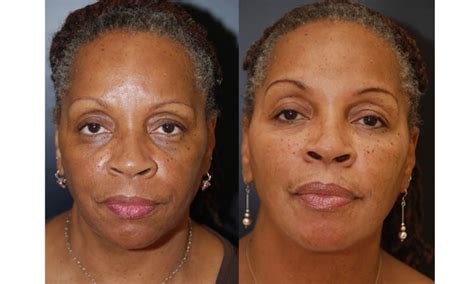 Treatment Suggestions For Deep Marionette Lines And Jowls Dr Dean Kane