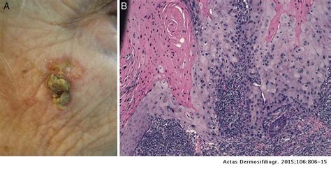 Squamous Cell Carcinoma Clinical And Pathological Features And