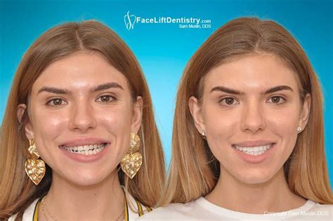 Maybe you would like to learn more about one of these? Before and After Photos: Underbite, Overbite, Open Bite in ...
