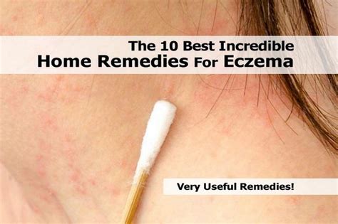The 10 Best Incredible Home Remedies For Eczema