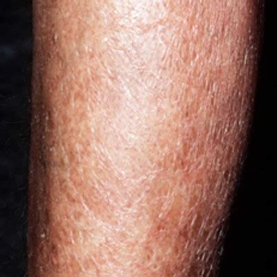 Itchy white bumps on my legs symptoms. Itchy Lower Legs - Causes, Treatment, Remedies
