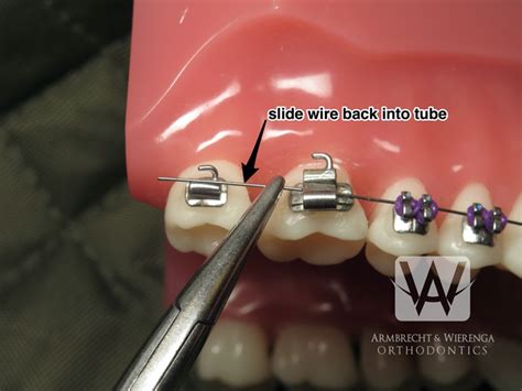 How To Cut Braces Wire With Nail Clipper Ortho Help Kamatovic Orthodontics When Your