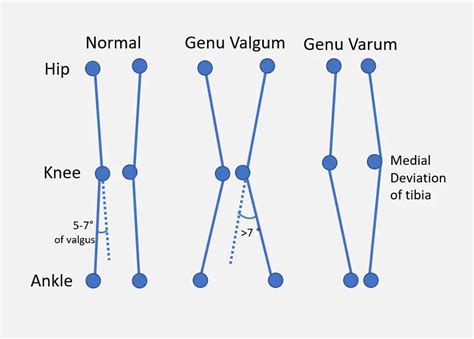 What Is Valgus Knee And When Is It A Problem Massage And Fitness Magazine