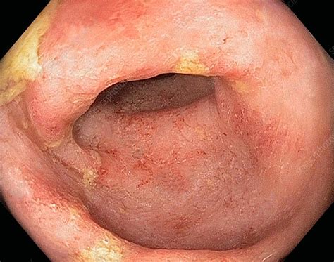 Review and cite ulcerative colitis protocol, troubleshooting and other methodology information | contact experts in ulcerative colitis to get answers. Ulcerative colitis - Stock Image - C014/6902 - Science ...