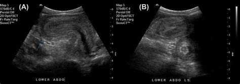 Transverse And Longitudinal Ultrasound Images Of The Lower Abdomen Of