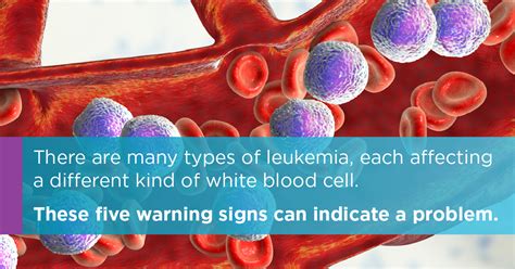 What Is Leukemia Types Symptoms And Treatment Upmc Healthbeat