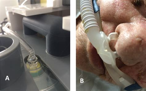 Nasal Cannula Wrong Placement Placement Of Nasal Oxygen Catheters Clinician S Brief A Nasal