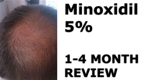 Minoxidil Facial Hair Before And After