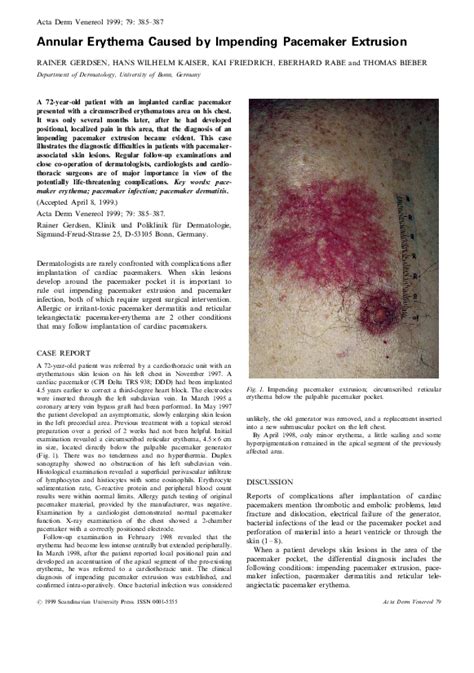 Pdf Annular Erythema Caused By Impending Pacemaker Extrusion