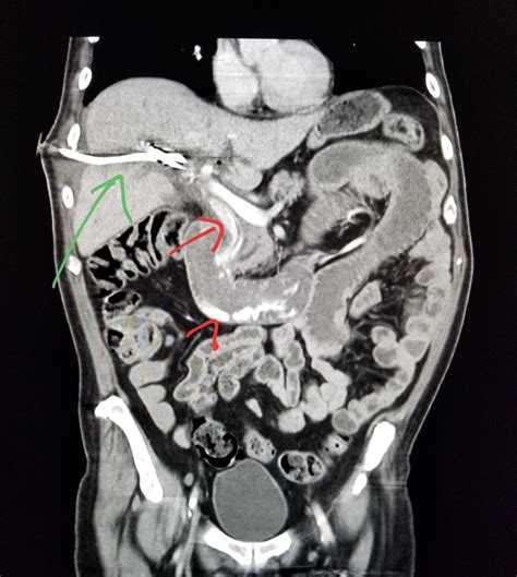 What Does Colon Cancer Look Like On A Ct Scan With Contrast What Does