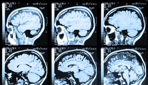 Mri Can Detect Early Stages Of Alzheimers Disease