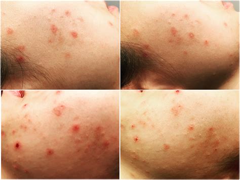 What are the benefits of lymphatic drainage massage? The Role of Inflammation in Acne - The Movement Clinic ...
