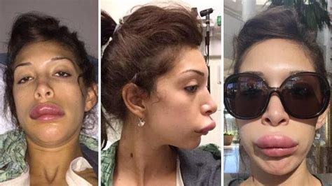 ‘teen mom star farrah abraham reveals botched lip job on twitter al arabiya english