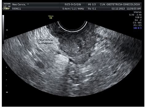 Transvaginal Ultrasound Showing A Large Cervical Cancer In Transverse