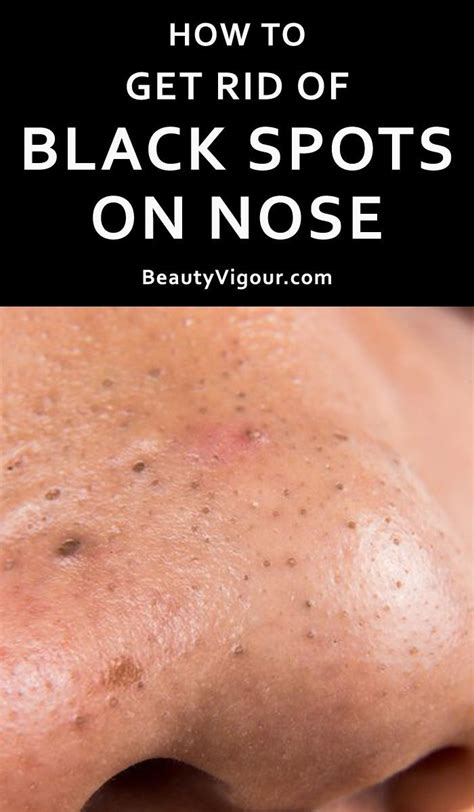 How To Get Rid Of Black Spots On Nose Brown Spots On Face Brown