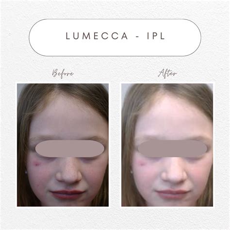 Lumecca Ipl Clear Skin Aspire Care Clinic