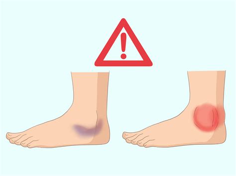3 Easy Ways To Wrap An Ankle With An Ace Bandage Wikihow