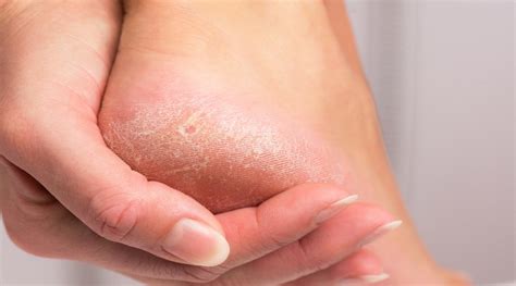Causes Treatment For Dry And Cracked Skin Advanced Foot Ankle