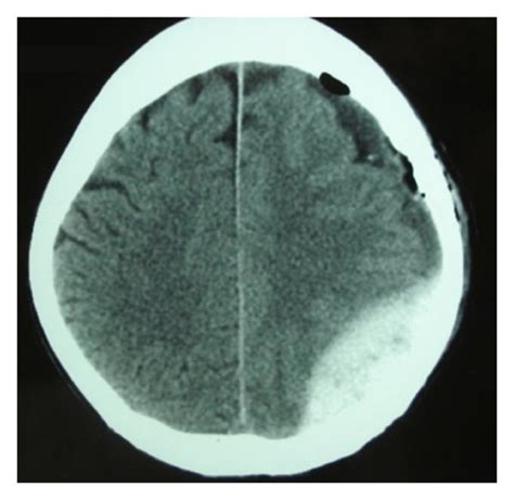 Postoperative Ct Scan Demonstrating A Large Left Parieto Occipital
