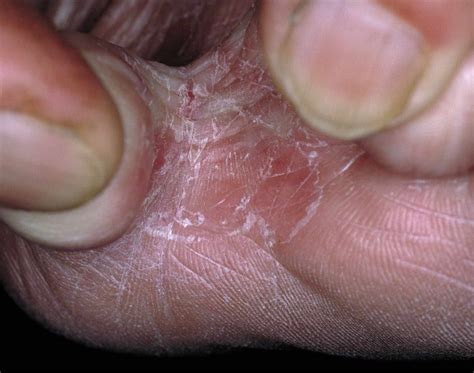 Athlete S Foot Symptoms Causes And Treatment