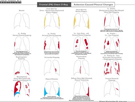 The case provides new insights in the development and properties of pleural lesions and may offer new options for the management of. Asbestosis Diagrams - Breader