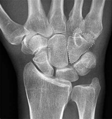 Wrist Trauma Radiographic Evaluation Hand Orthobullets