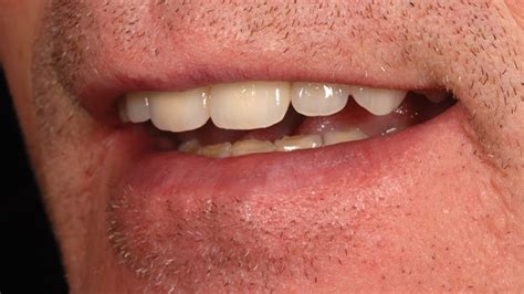 Dentures Replace Missing Teeth No9 Dental Practice