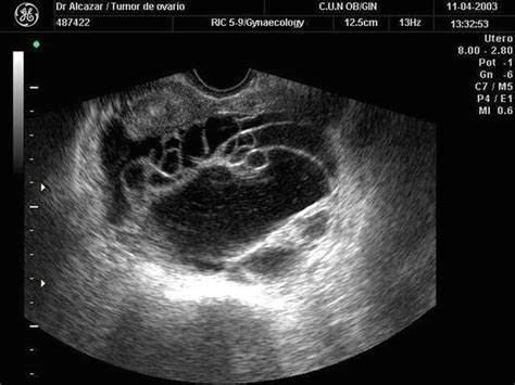 Ultrasound scans use high frequency sound waves to create a picture of. Malignant Ovarian Tumors (Serous/Mucinous/Endometrioid ...