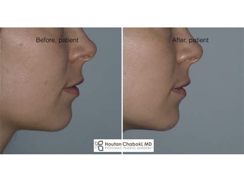 Relaxing A Dimpled Chin Muscle