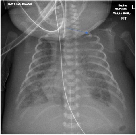 Chest Radiograph Demonstrating Picc Line With Position Of The Tip Blue